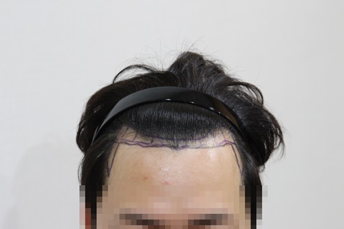 암흑기 탈출 5개월차 1500모낭 비절개했어요