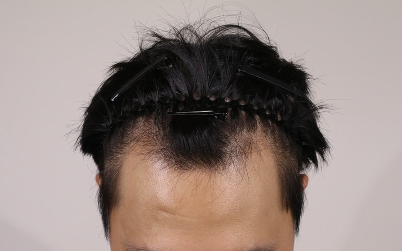 Apgujeong Moorim incision 3,000 hair transplant.