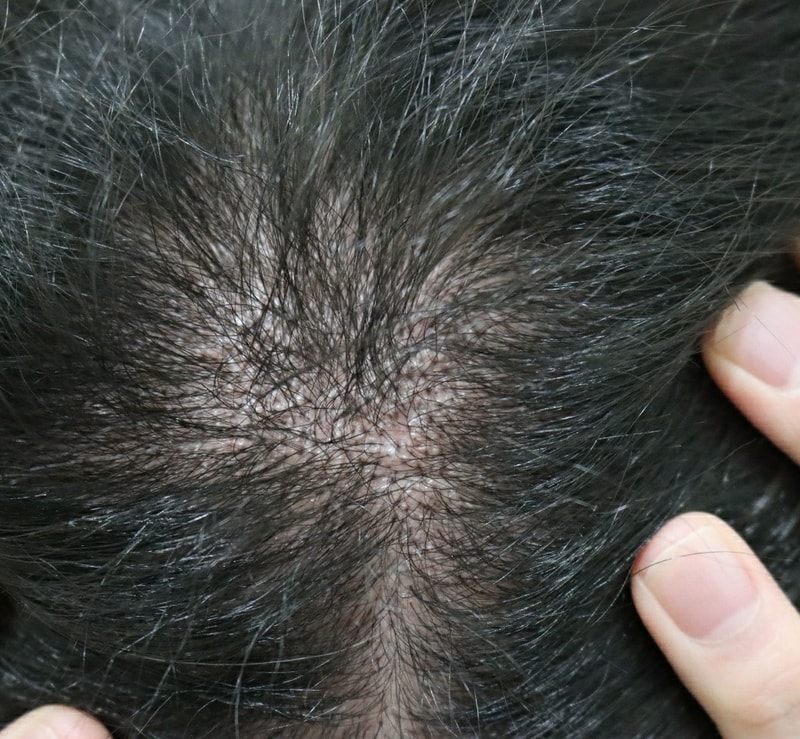 A review of the top of the head for 6 months