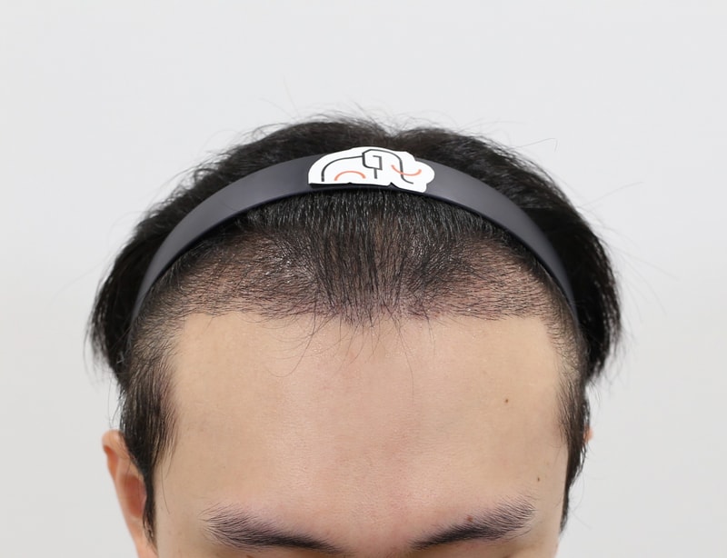 모발이식 자료 사진3.png.jpg
