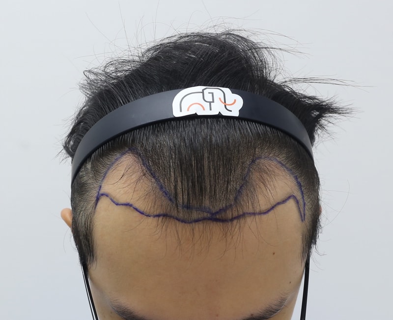 모발이식 자료 사진2.png.jpg