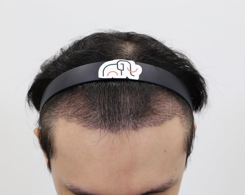 모발이식 자료 사진4.png.jpg