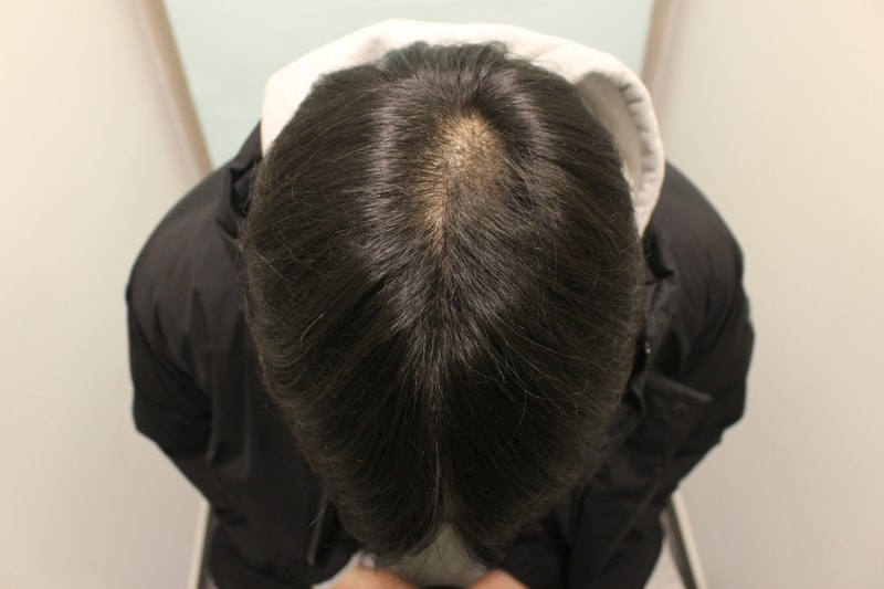 수술후 6개월 9.JPG