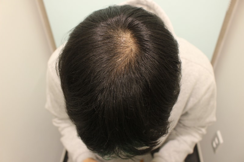 수술후 3개월 1.JPG