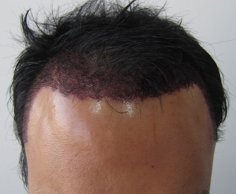 수술후 정면.jpg