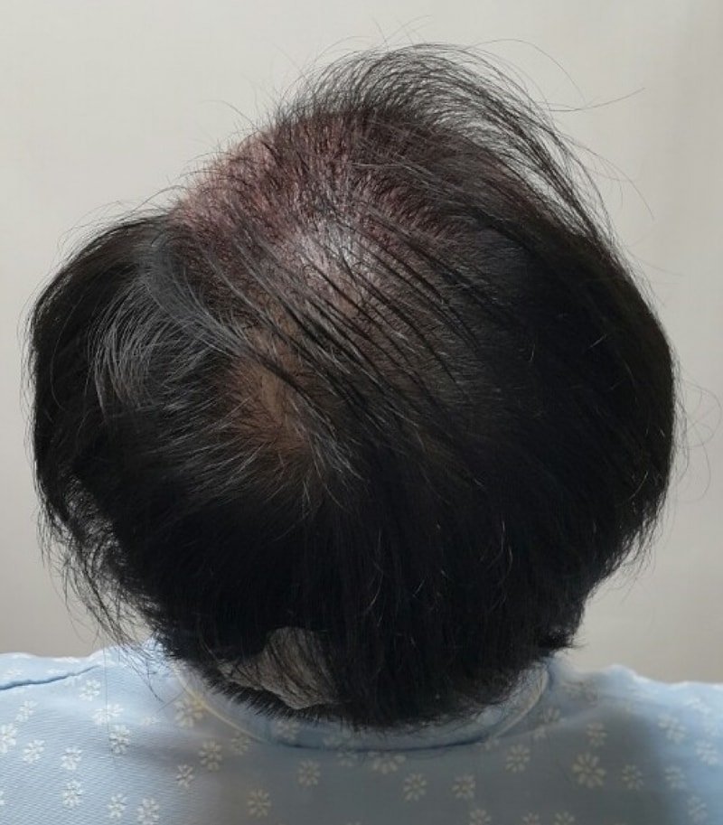 수술후 3.jpg