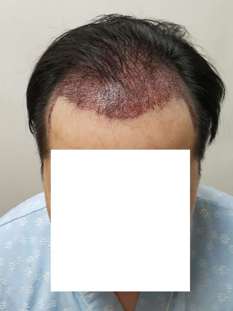 수술후 1.jpg