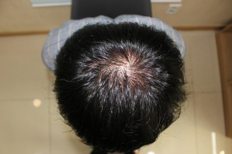 수술다음날 머리감은후.jpg