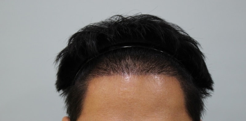 절개 10일차.jpg