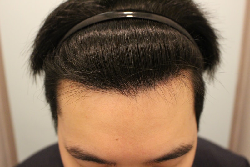 수술후 6개월 1.jpg