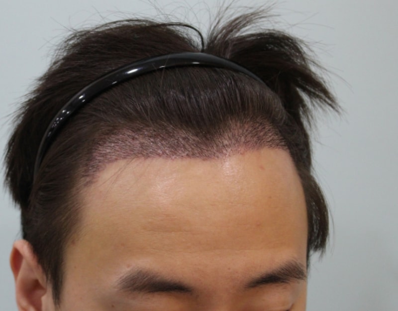 수술10일후.png