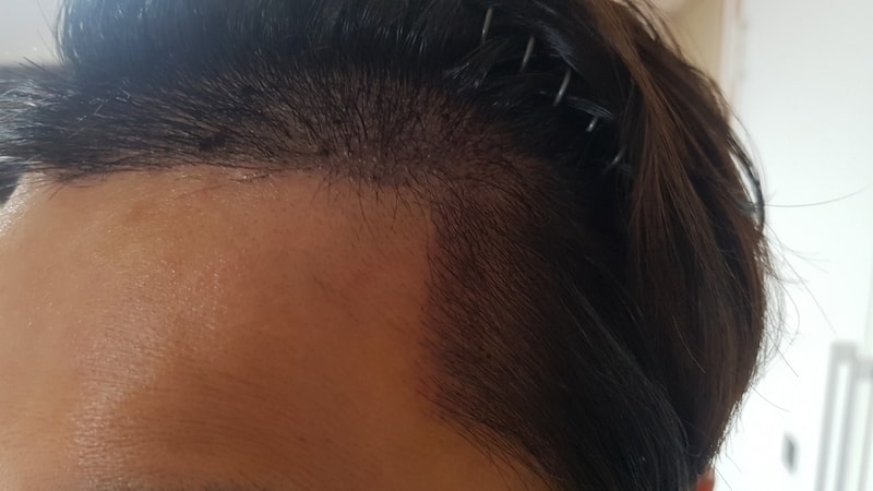 05 after_left(1 week).jpg