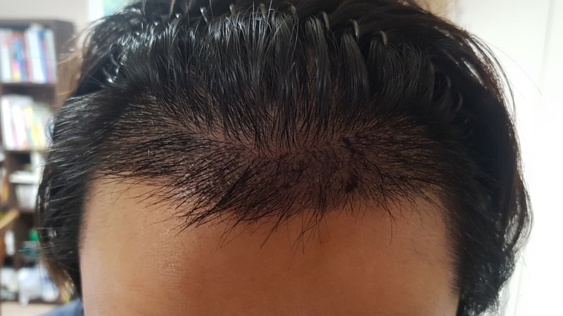 04 after_front(1 week).jpg