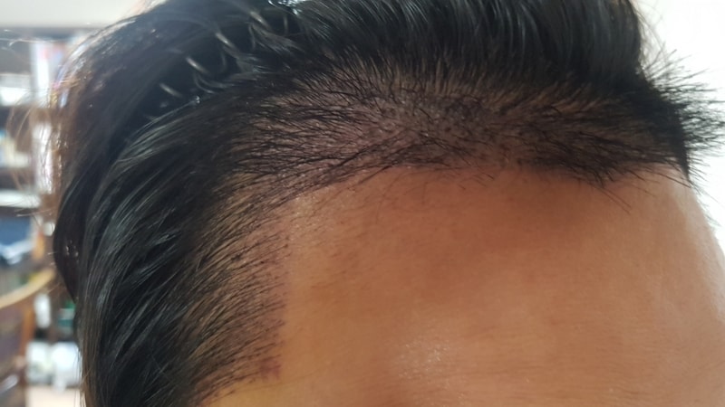 06 after_right(1 week).jpg