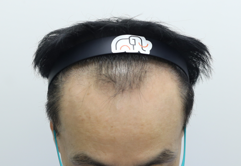 수술전.png