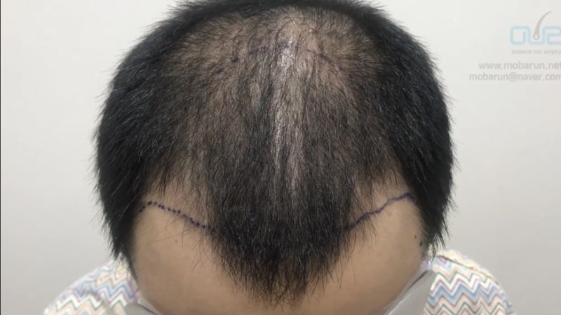 수술경과 1년 그리고 보강