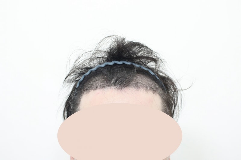 수술후10일차_1.jpg