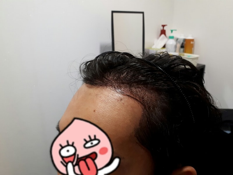 수술 다음 날 샴푸 후2.jpg