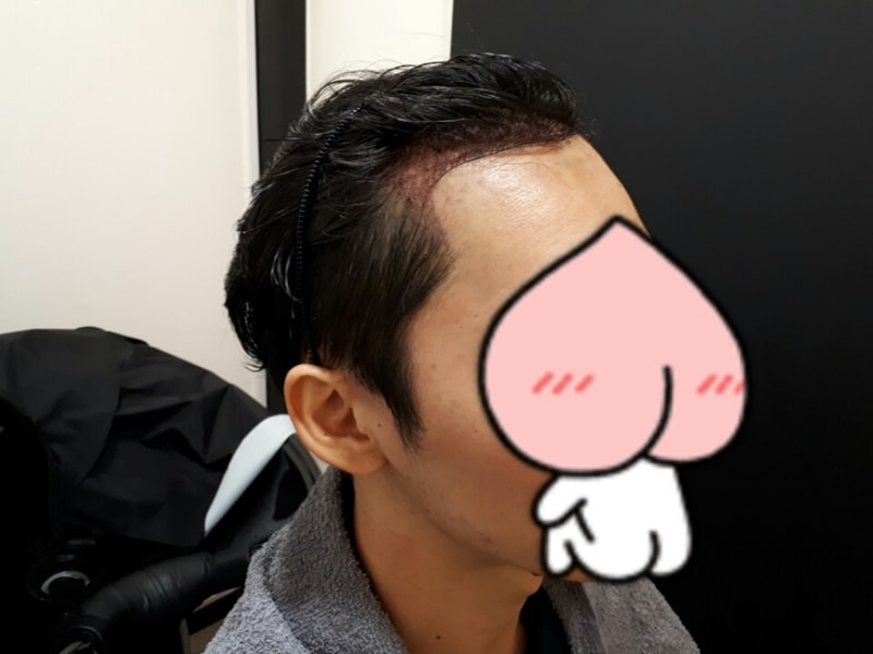 수술 다음 날 샴푸 후3.jpg