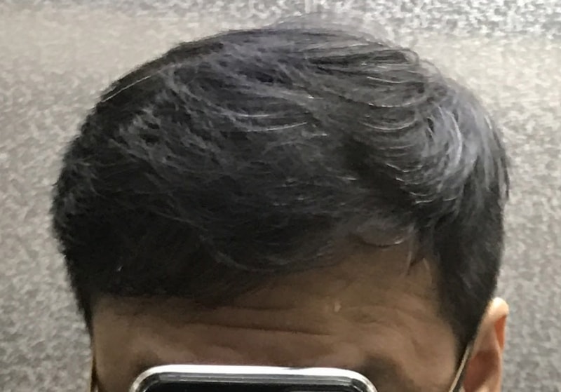 5-AS후 4개월3.jpg