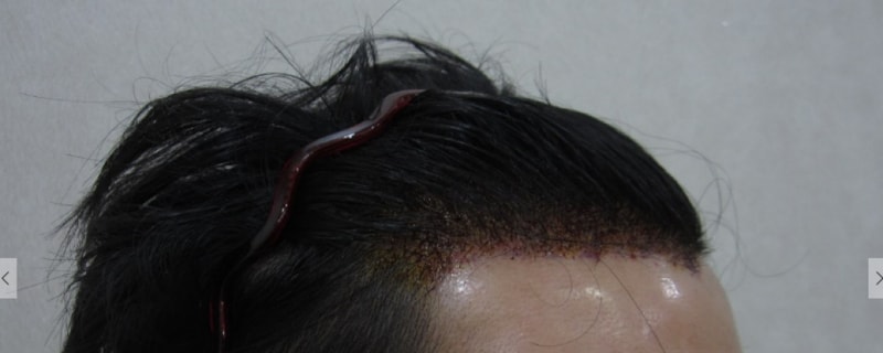 수술 사진3.png