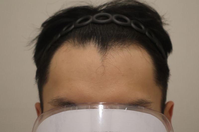 HAIRO 毛髪移植 Dongtan非切開植毛2700毛 手術後のレビュー