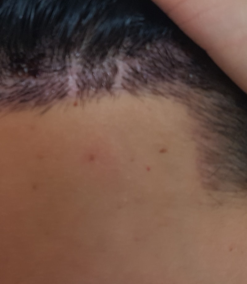 10일차 딱지제거 했는데 심하게 비어있는 부분이 있어요...