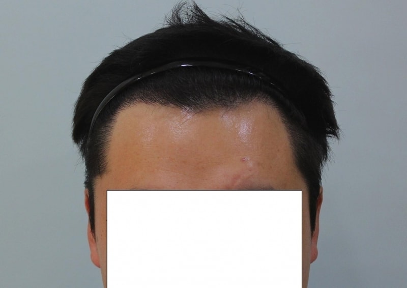 수술후 10개월 (1).jpg