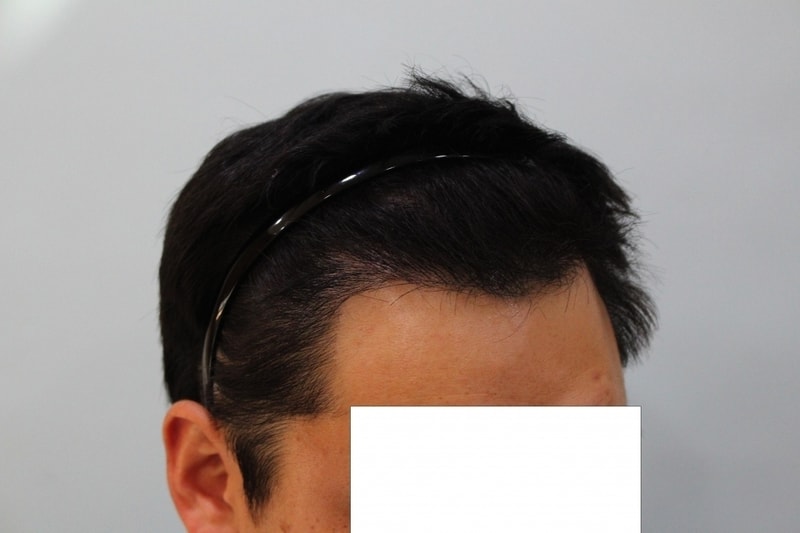 수술후 10개월 (2).jpg