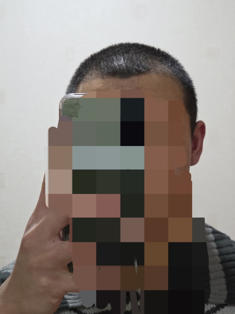 It is in 31 days Hair Transplant.