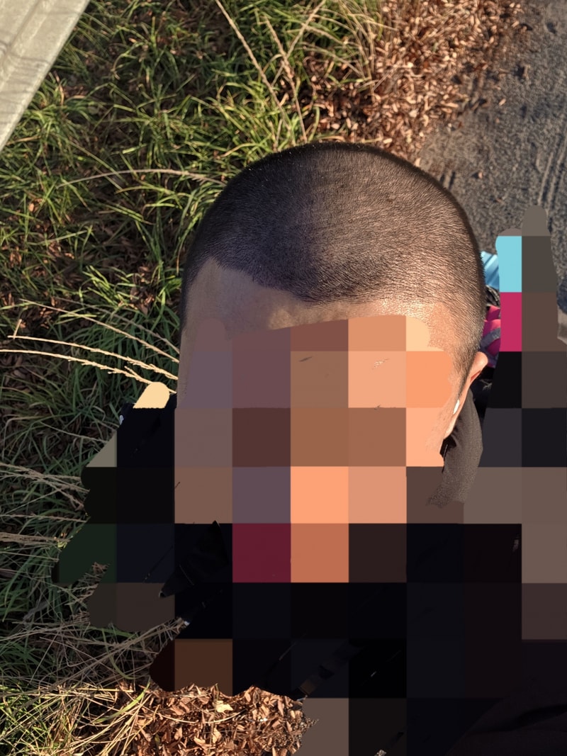 It's been 15 days since the Hair Transplant.