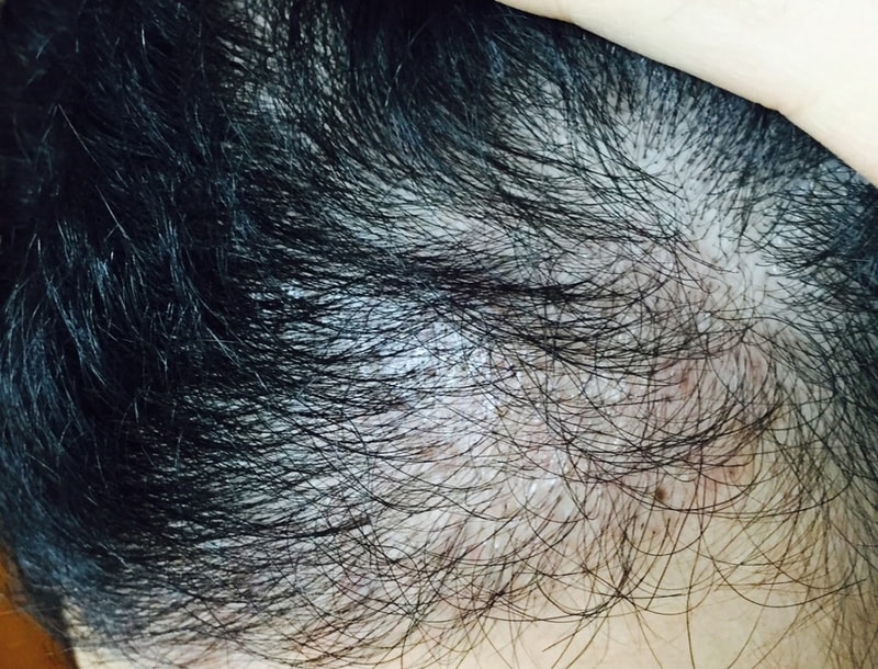 비절개 1400모낭 140일차