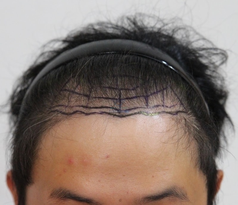 1500모낭 이식수술한지 1년 4개월 차