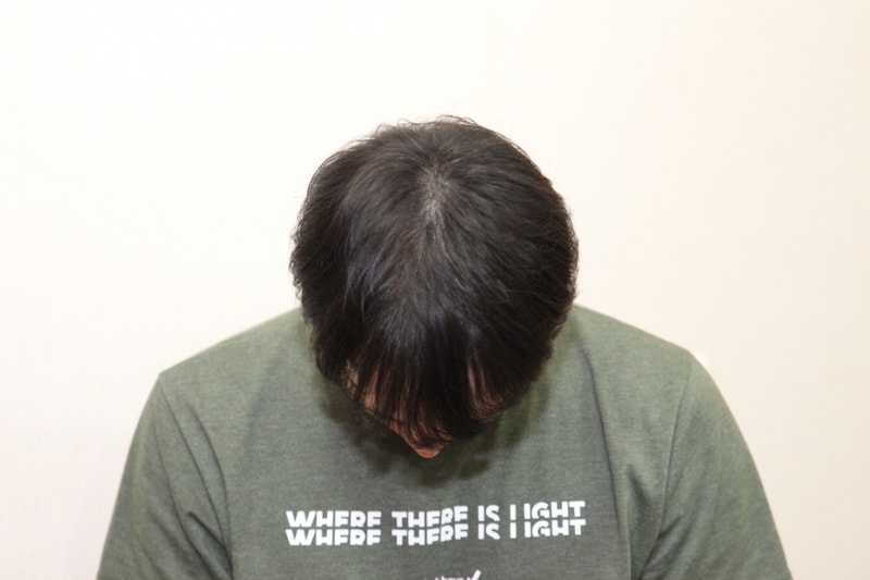 수술 후 정수리.JPG