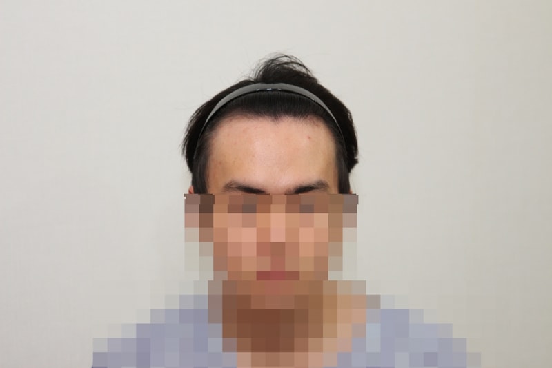 6개월이지나고 1년후입니다 ~