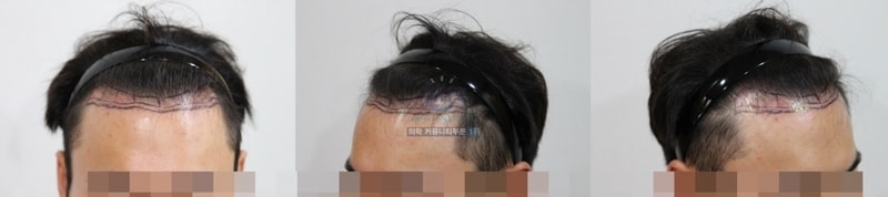 고밀도 슬릿! 1300모낭 설 앞두고 11개월~