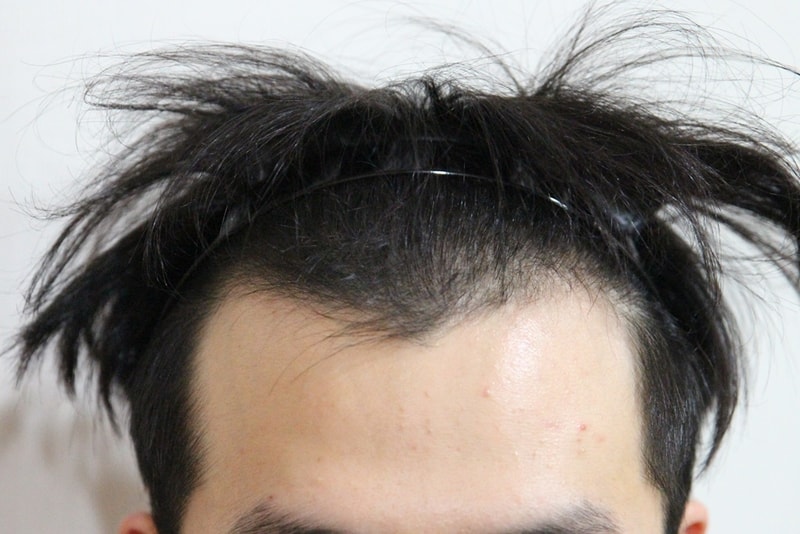 Transplant surgery 1500 hair follicles 4 weeks old