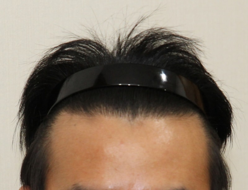 20180522 수술후3.jpg