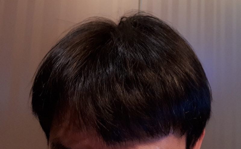 20180522 수술후5.jpg