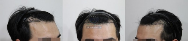 비절개슬릿 모발이식1300모낭  1년!!