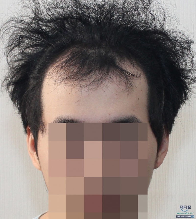 뉴헤어 3000모 모발이식수술 1년