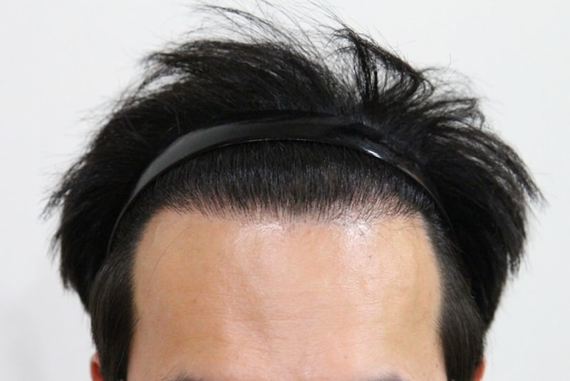수술1년 (2).JPG