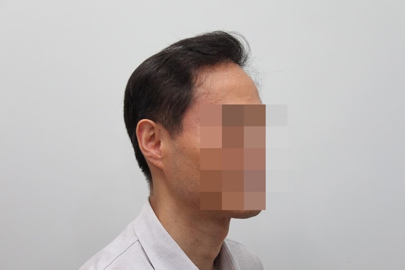 수술후1년.jpg
