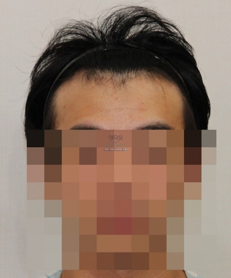 1년 반 지나고 뒤늦게 2500모 후기올립니다.