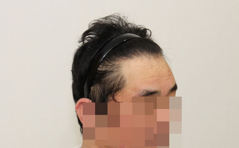 수술후 1년_2.JPG