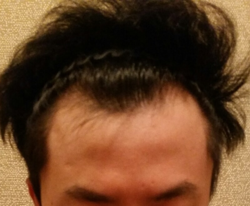(사진스압~)이식 2000모 1년~ 머리 다 자랐습니다 ㅋ