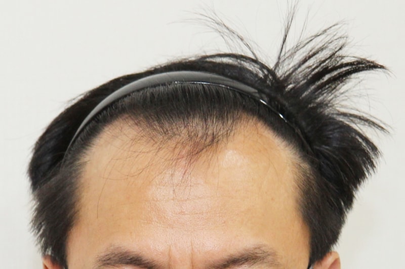 1500모낭 수술후 1년3개월째네요 ...