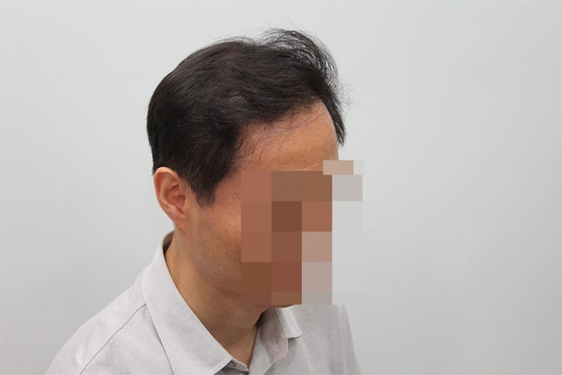 수술후 1년.jpg