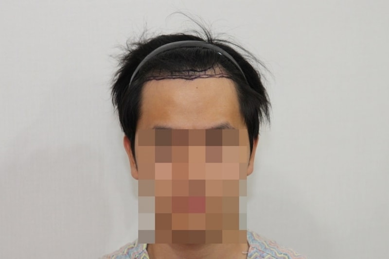 앞머리 1300모낭 수술 6개월 경과 후기 올립니다!