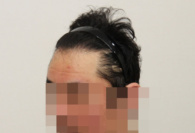 수술후 1년_1.JPG